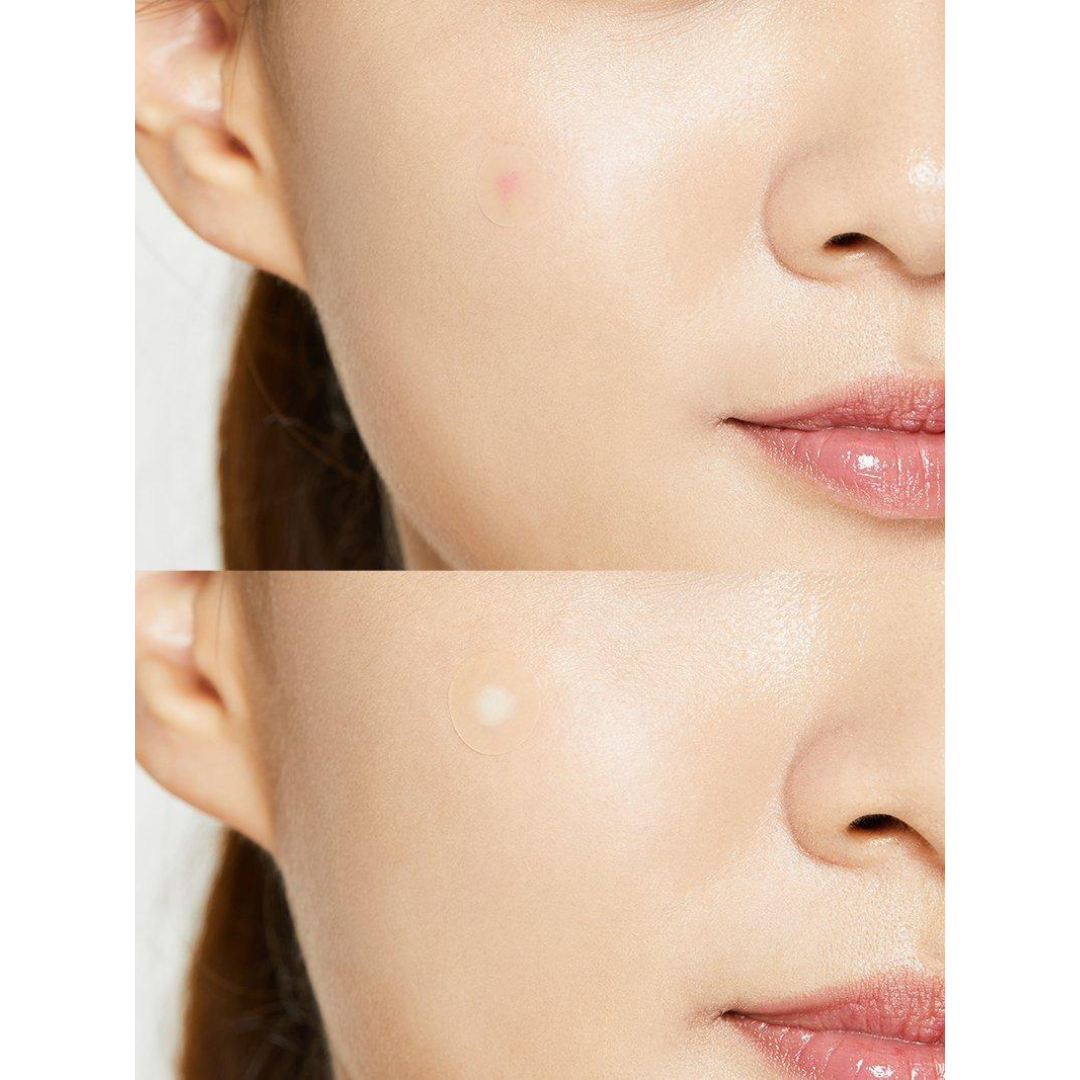 Acne Pimple Master Patch - Parches para Acné y Espinillas